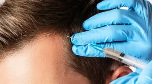 Doctors’ Recommendations for Male Hair Loss Treatments